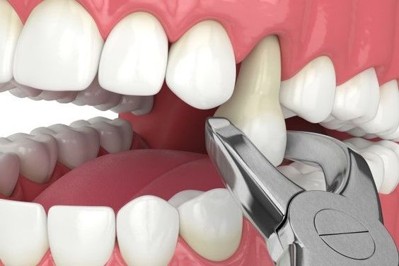 Dental Extraction