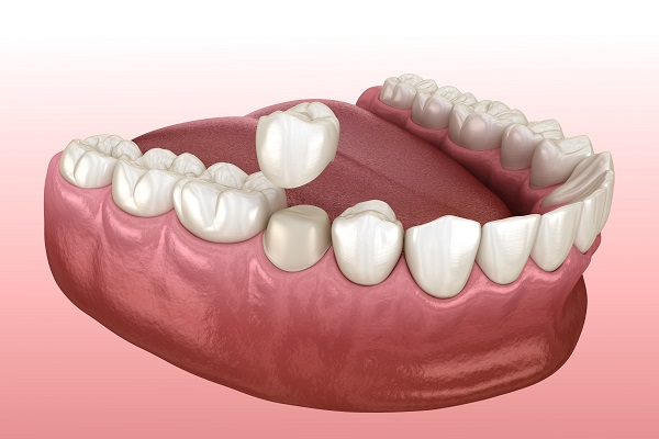 Dental Restoration