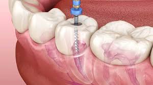 Root Canal Treatment