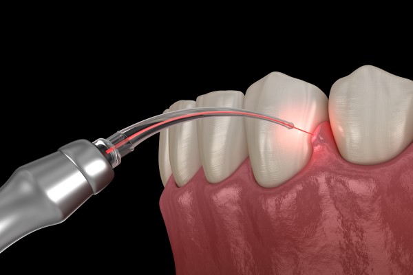 laser treatment